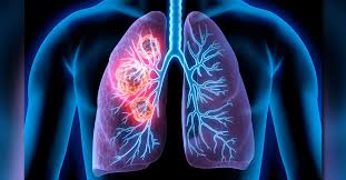 Leading Cancer Specialist in Dubai for Accurate Diagnosis & Treatment